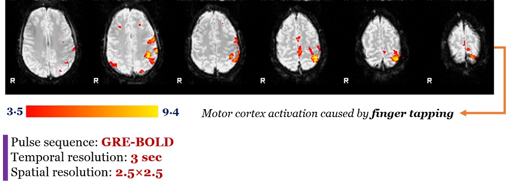 Functional MRI (fMRI)